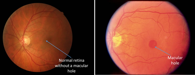 macular hole