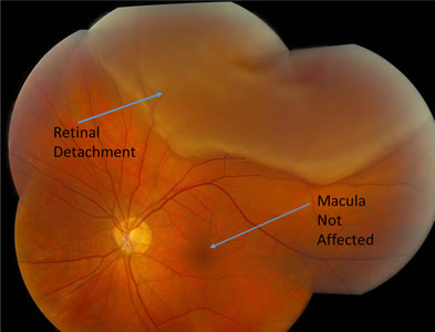 retina