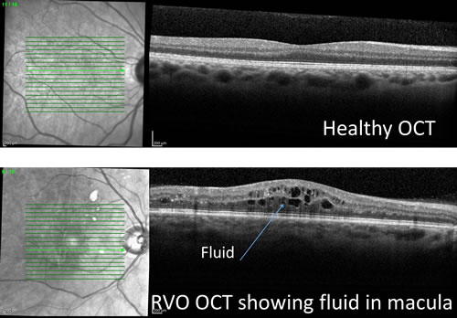 fluid in OCT