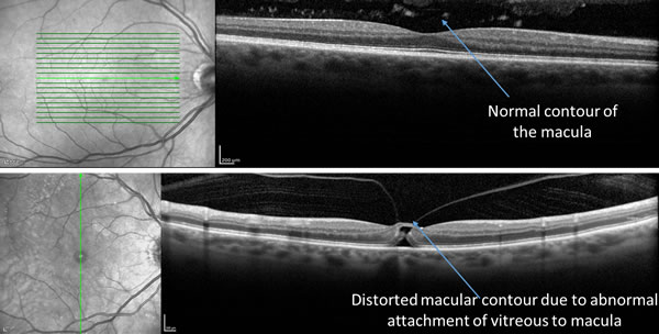 Vitreomacular Traction Syndrome