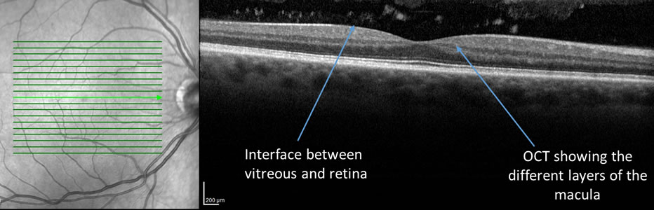 Vitreomacular Traction Syndrome