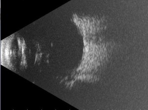 B-Scan Eye Ultrasound