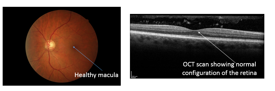 epiretinal membranes