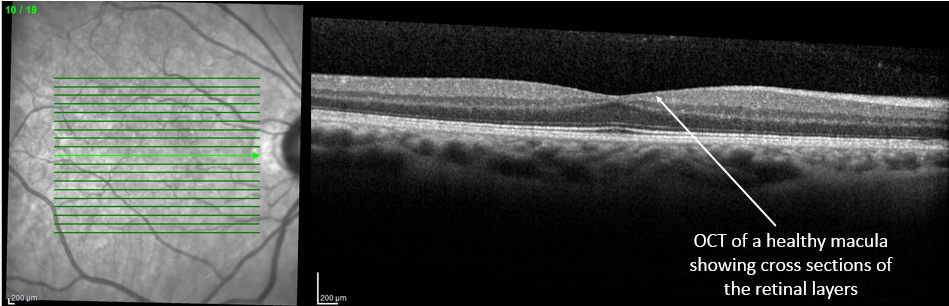 epiretinal membranes