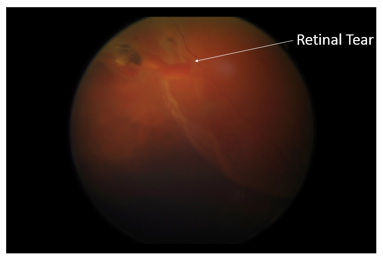 retinal detachment