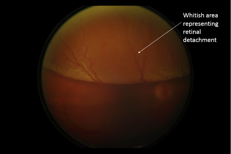 retinal detatchment