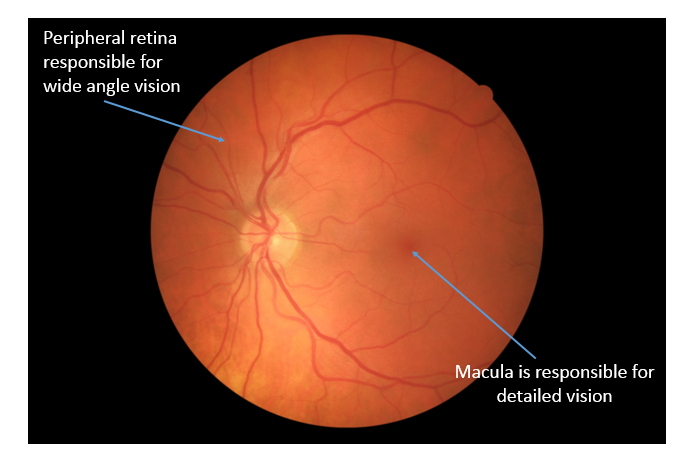 Vitreomacular Traction Syndrome