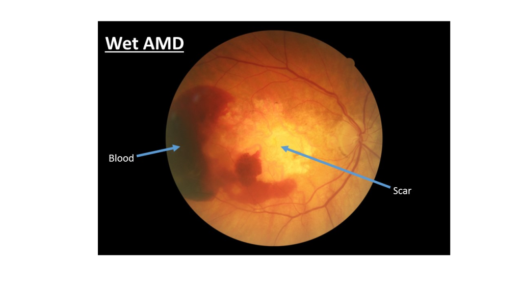 Wet Amd